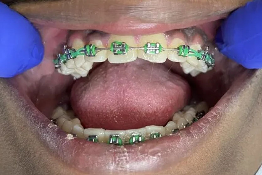 ¿DE QU ? ESTÁN HECHOS LOS Brackets de Metal?