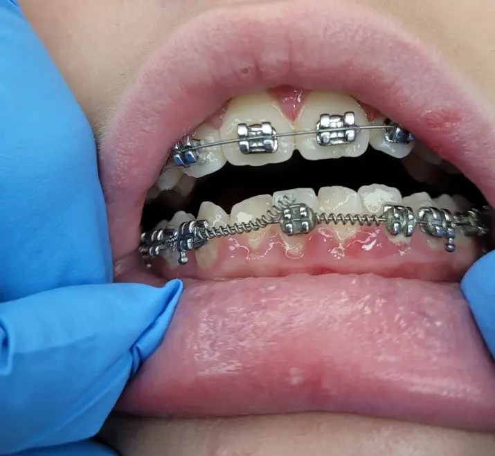 diamondbraces patient loose wire poking