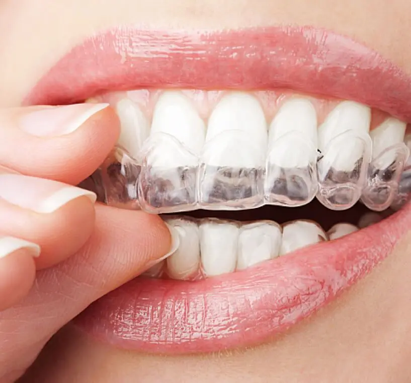 diamondbraces Invisalign Braces Compared Invisalign Pros