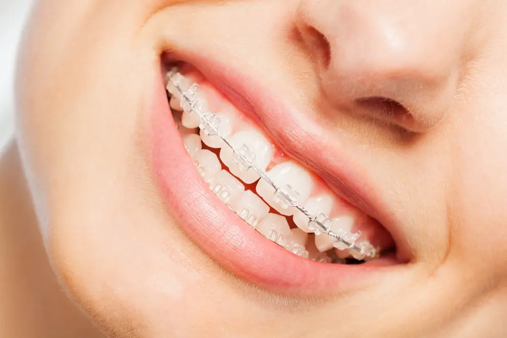 ¿Qué son los brackets de cerámica?