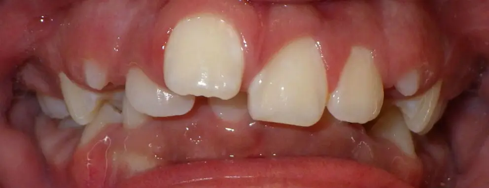 CAN Invisalign Aligners Correct Crowding