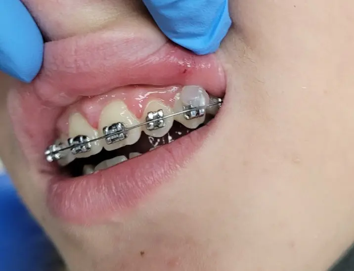 paciente de Diamond Braces con llagas y cera