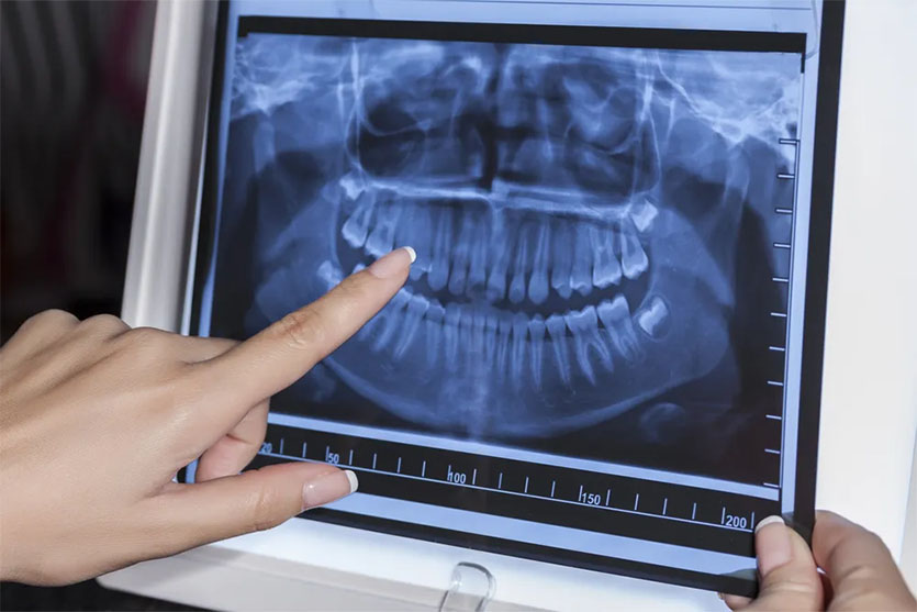 ¿QU ? SON Rayos X Dentales Digitales