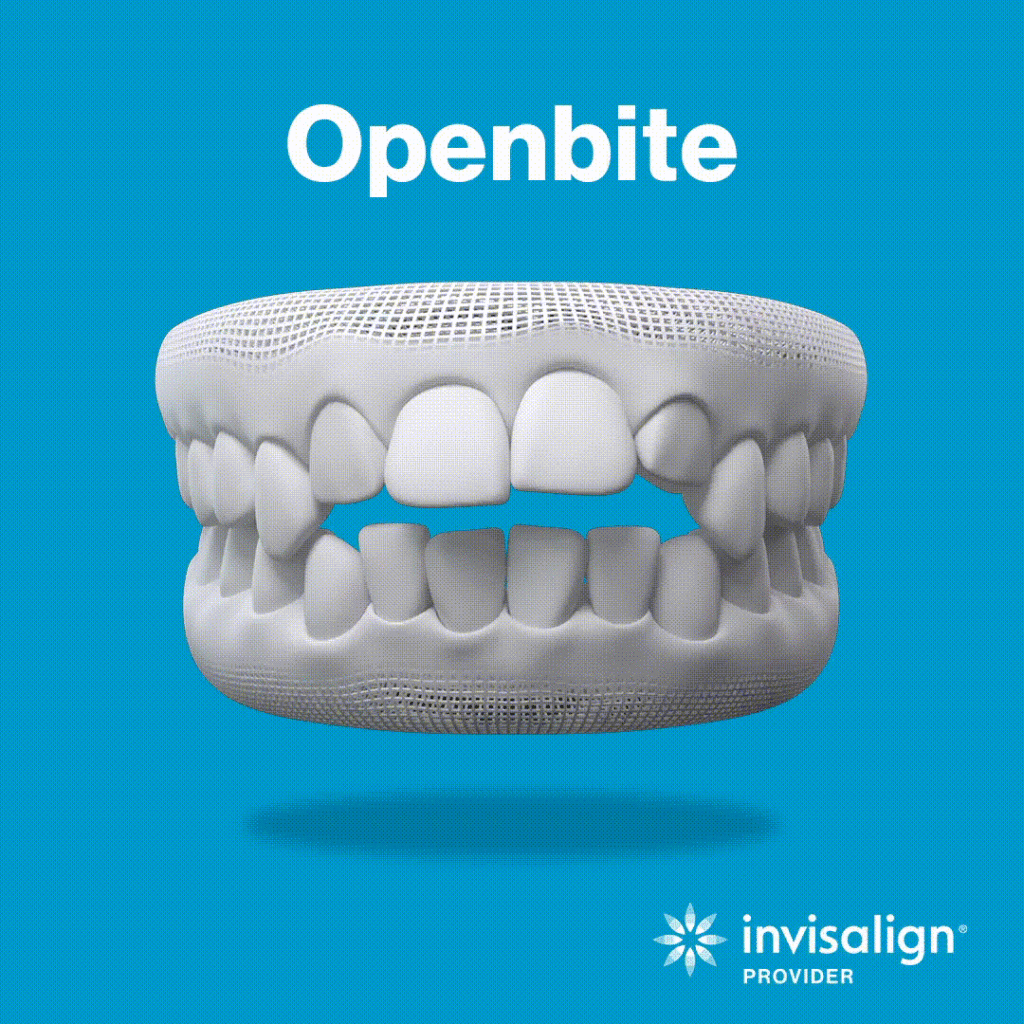 invisalign open bite