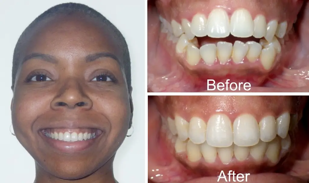 open bite before and after invisalign treatment years old female front view