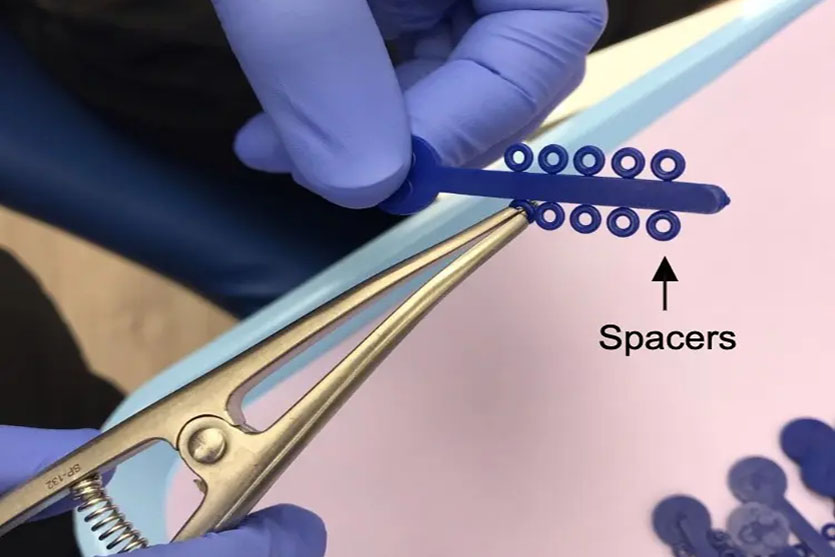 ¿Qué son los Separadores Ortodónticos y cómo funcionan?