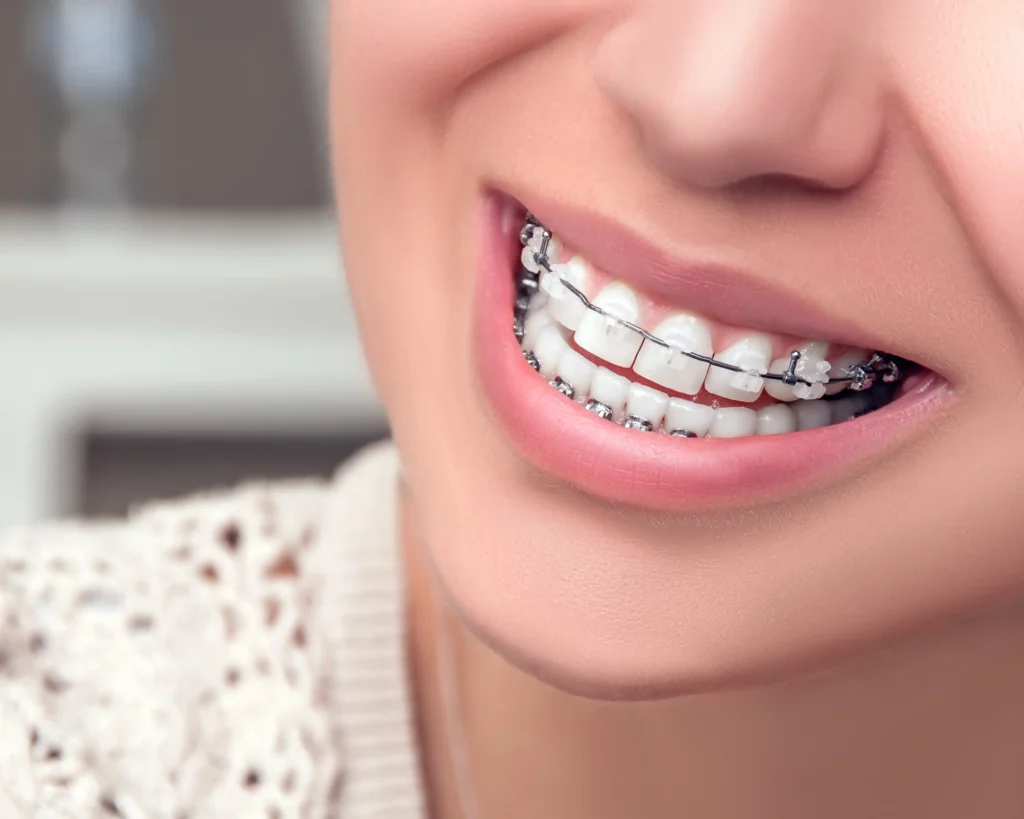 ceramic braces near you astoria queens