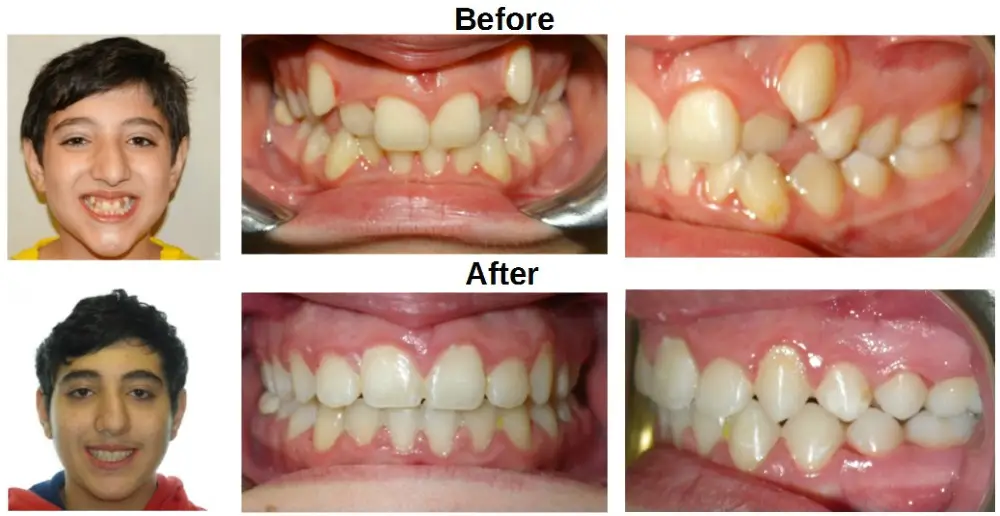 Erik Smiling After Braces Treatment