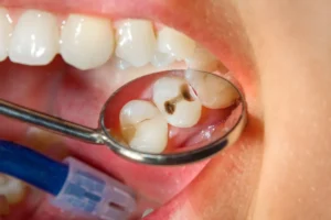 ¿Puedes Obtener Alineadores Si Tienes Una Caries?