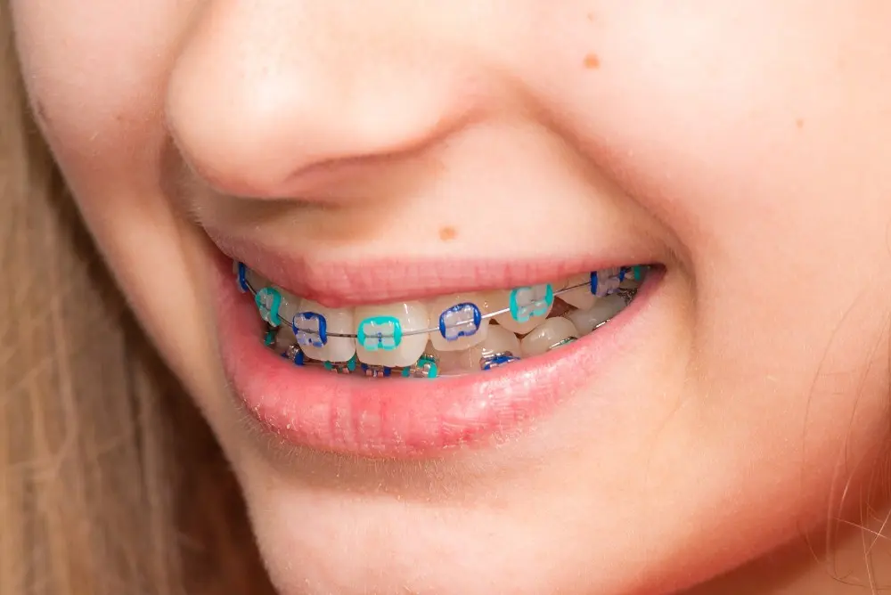 Fun and Festive Braces Color Combinations for Every Occasion: A Video Guide