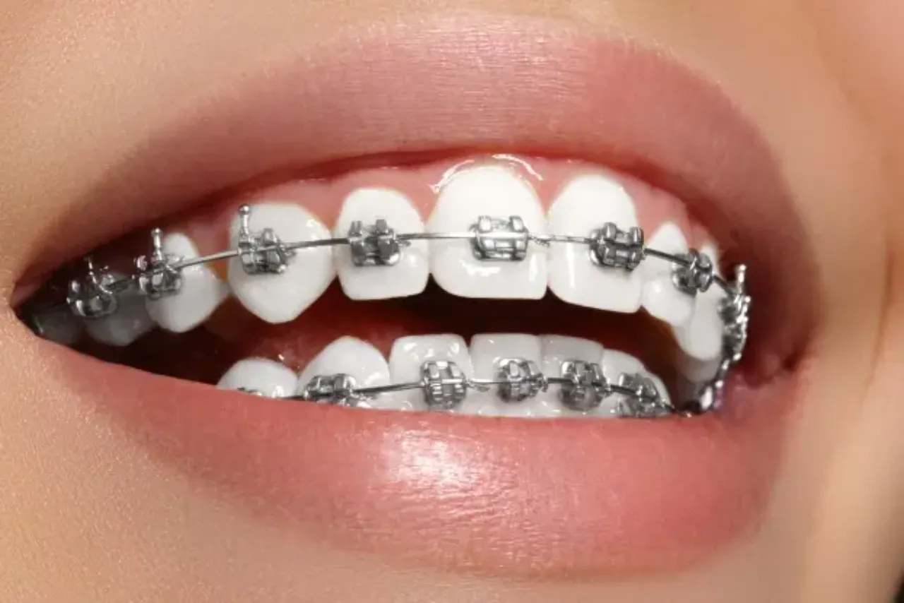 colores de brackets para adultos