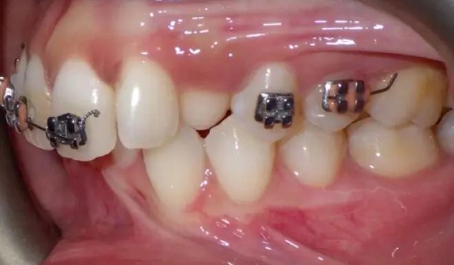 diamondbraces patient with broken bracket