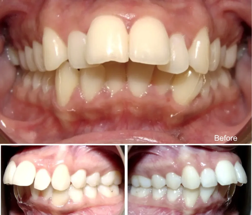 Jugdeep, 23 años, sobremordida y protrusión antes del tratamiento con Invisalign