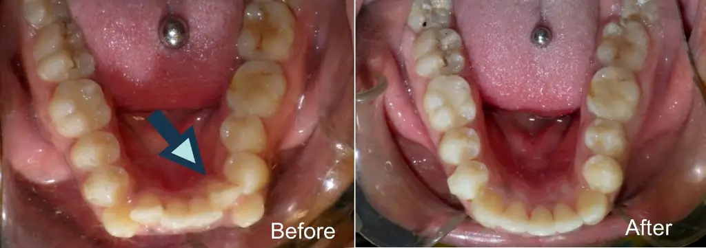 Alonda years old lower front crowding removal of lower incisor and months Invisalign treatment before and after