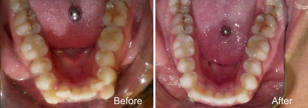 Alonda years old lower incisor extraction case with Invisalign treatment