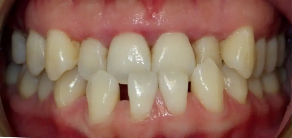 Anterior Crossbite