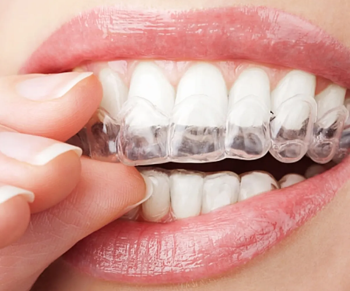 Invisalign para adultos en Diamond Braces Sheepshead Bay, Brooklyn, NY