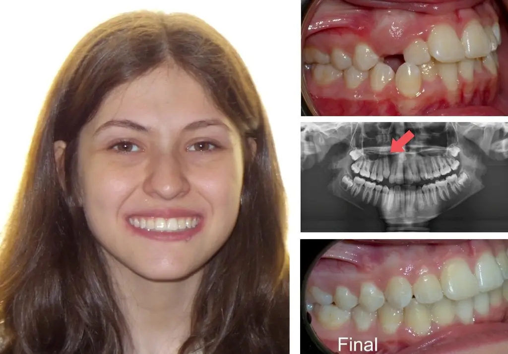 Female Years Old with Impacted Teeth Before and After Treatment