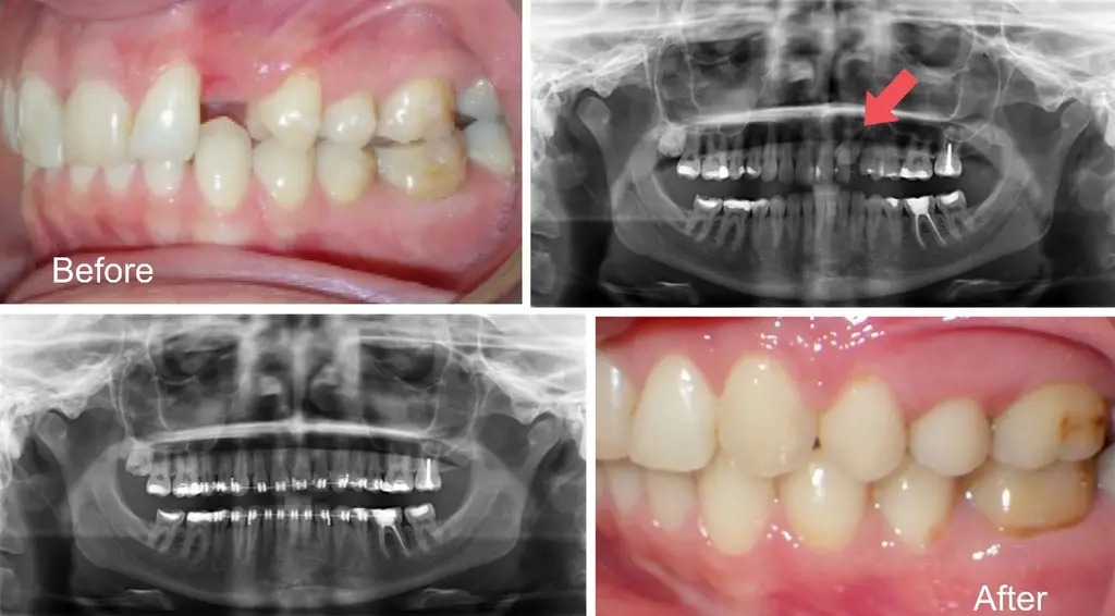 Female Years Old with Impacted Teeth Before and After Treatment with Braces