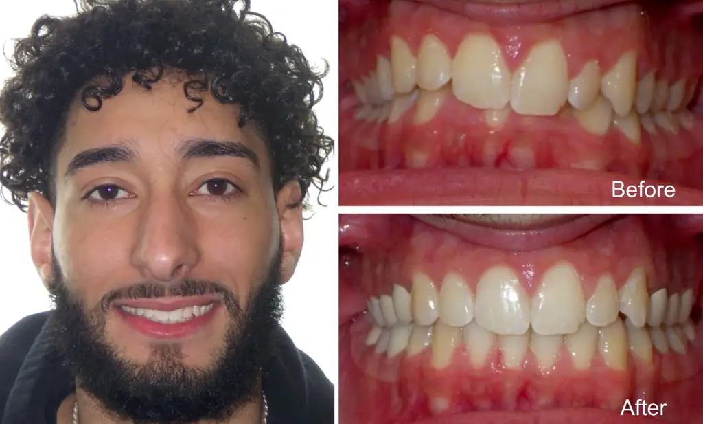 Male Years Old with Overbite Before and After Invisalign Treatment