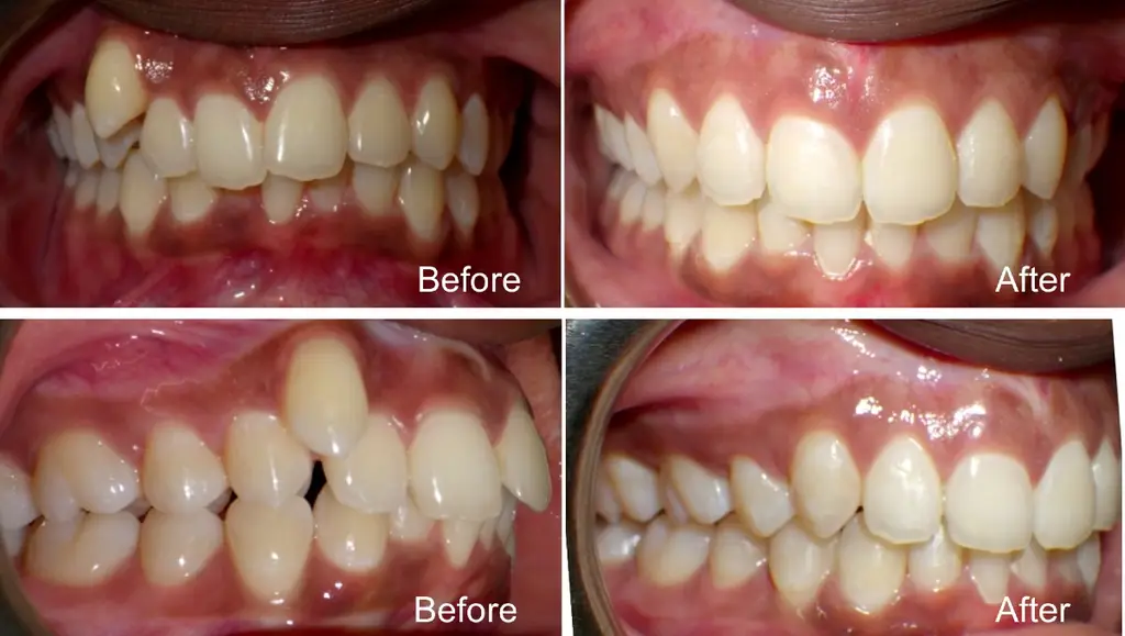 Nia years old Crowding and Overbite alleviated with extractions and Invisalgn treatment before and after