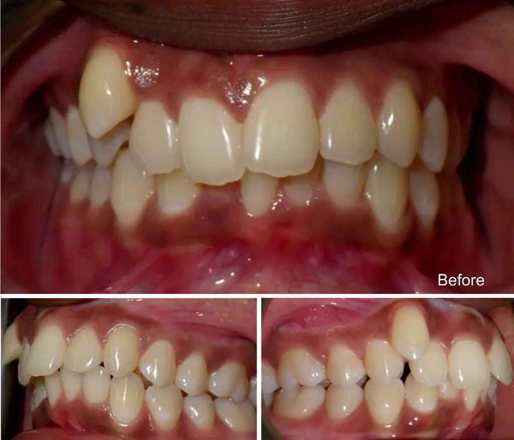 Nia years old extraction case before Invisalign treatment