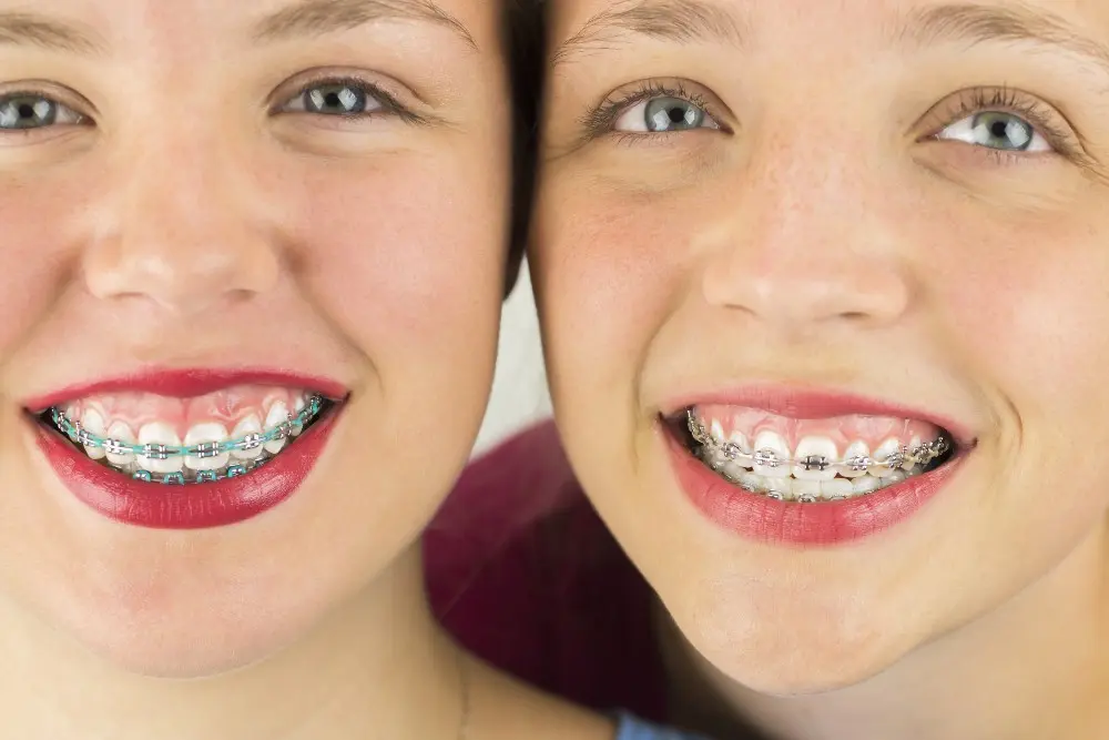 Descubre los Mejores Colores para Brackets