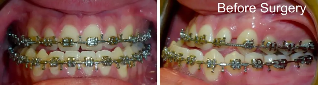 jay years old crossbite surgical case before surgery