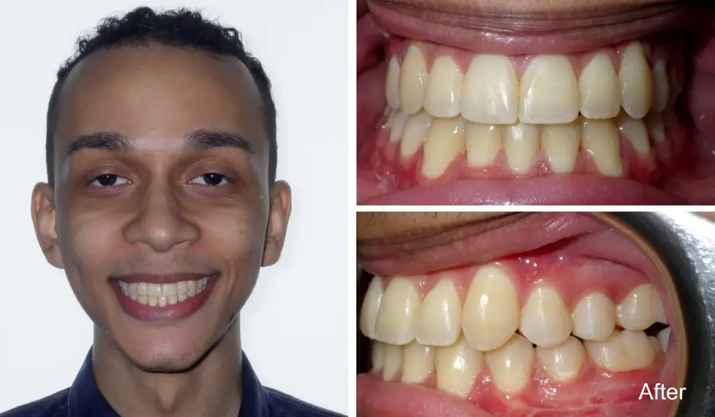 manuel years old crossbite sugical correction after treatment