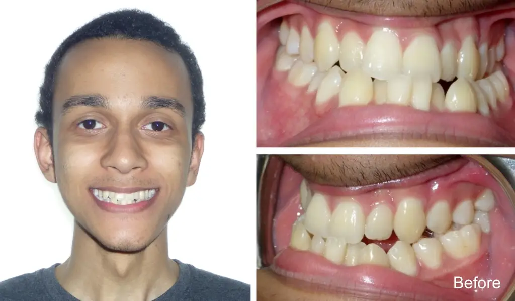 manuel years old crossbite sugicalcorrection before treatment