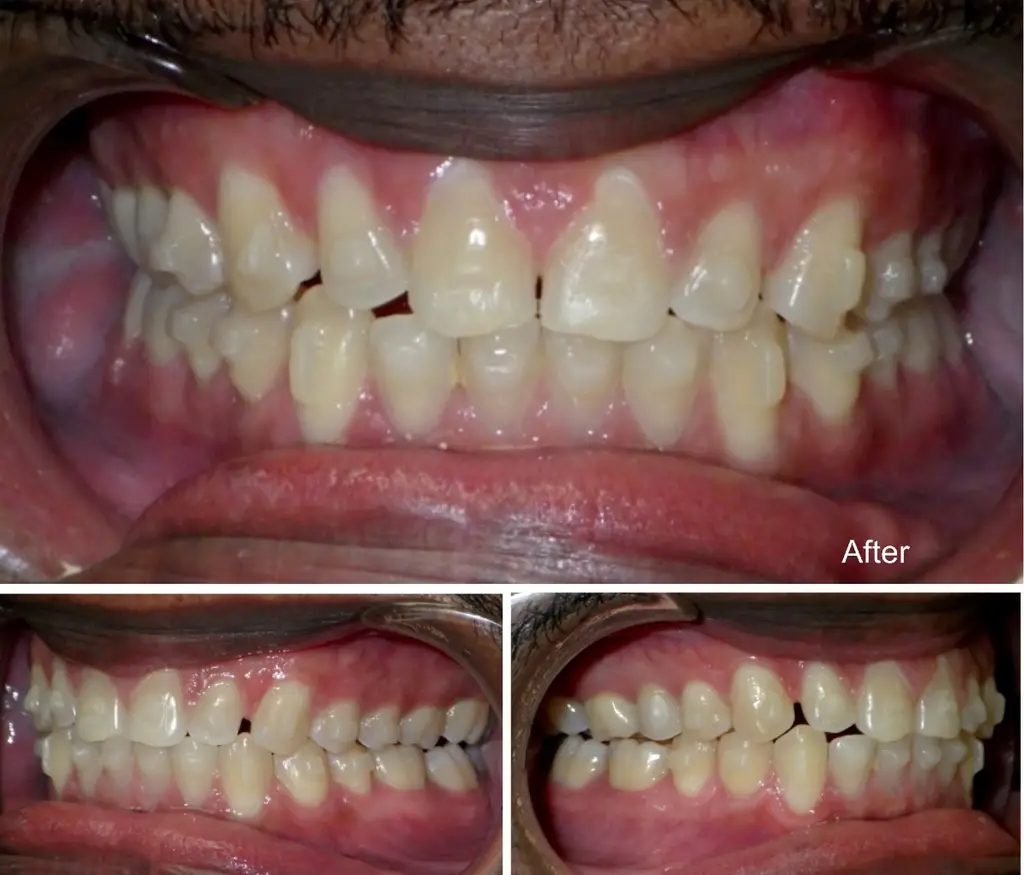 nigel years small teeth spaces closure after Invisalign treatment