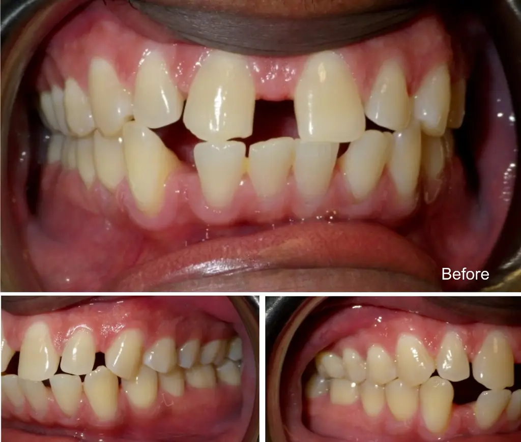 nigel years small teeth spaces closure before Invisalign treatment